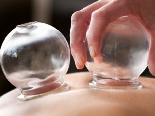 Chinese Cupping Therapy