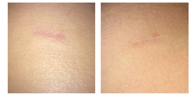 Scar Reduction Results Microneedling