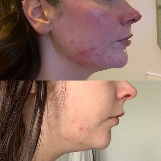 Before and after skinthings